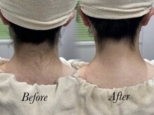 クイーン 渋谷店(QUEEN)/脱毛前に