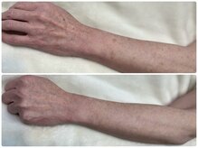 ジーナ(Ginna)の雰囲気（コンプレックスだった手や腕のシミのケア。白い手は若さの秘訣！）