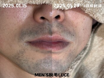 ルーチェ/【ヒゲ脱毛】1回照射