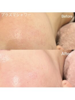 リンダ 西宮店(LINDA)/プラズマシャワー