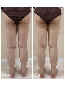 リミュール(Ri.miyuru)/下半身リンパマッサージ