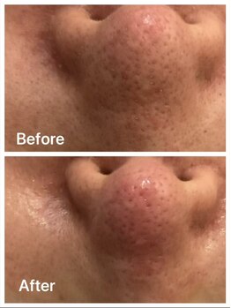 サロンモリ(Mori)の写真/【冬の乾燥による毛穴のダメージを徹底ケア♪】《ハーブピーリング&毛穴洗浄》で毛穴ケア♪90分¥9980