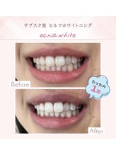 セルフホワイトニングサロン　エクシアホワイトニング宇治小倉店/ビフォーアフター