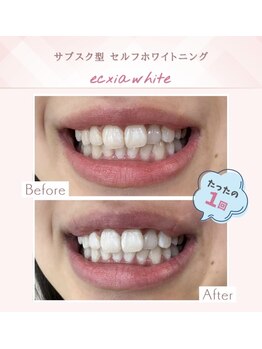 セルフホワイトニングサロン　エクシアホワイトニング宇治小倉店/ビフォーアフター