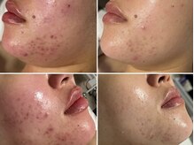 アキュセル 高槻(Accu:cell)の雰囲気（高槻/お肌専門ナースが毛穴　ニキビケア　シミケア　くすみ）