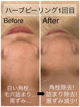 ロイ(Loy)/鼻の毛穴メニュー♪（タップ）