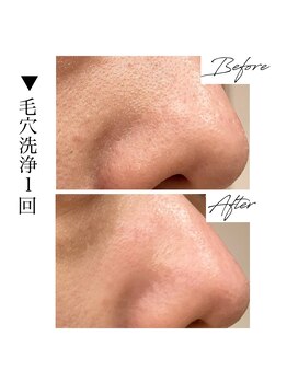 ビズビズ 梅田店(bisebise)/〈症例〉毛穴詰まり