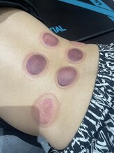 ヒールジョイ(HEAL JOY)/カッピング追加することも！！