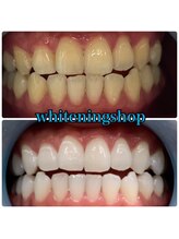 ホワイトニングショップ 豊橋店(WHITENING SHOP)/Before&After豊橋ホワイトニング