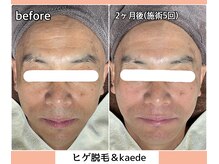 ベルミーランド 浜松天王/フェイシャルBefore→After