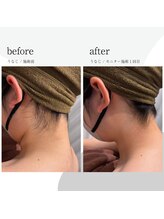 コンフォート ミヤ(comfort miya)/うなじ脱毛before/after