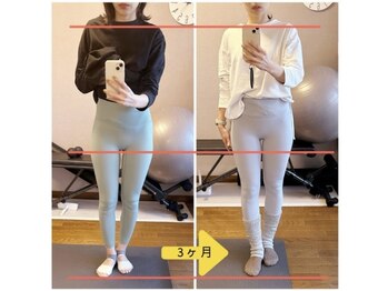 ポノフィット(PONO FIT.)/症例／ヒップ（脚長）