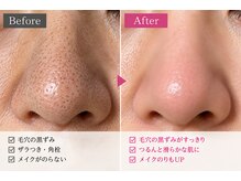マナ(mana)の雰囲気（1度で効果◎毛穴開き／毛穴黒ずみ／毛穴詰まり／毛穴ざらつき）