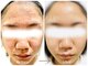 メイリー(MEILLI)の写真/肌悩みで困っている方に一度は体感していただきたいダメージリセットフェイシャル