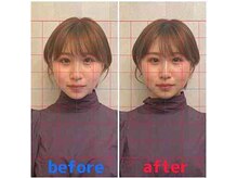 ルディア 堂島店(ledia)/西梅田美容鍼1回での変化