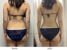 スラリ(SLARI)/【背中　脂肪冷却】