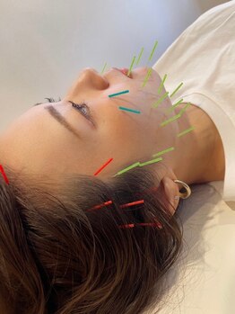 ナック整骨院の写真/美容鍼デビューに◎カウンセリング付き美容鍼 ◆肌のターンオーバーを整え、ハリのある艶肌&リフトアップ♪