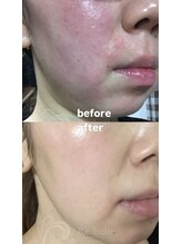 セレネ(SELENE)/肌の赤み、腫れ、痒み