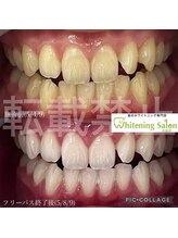 ホワイトニングサロン 広島店&nbsp;20回数券 