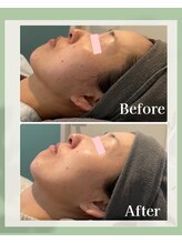 レトラ鍼灸院/ハーブピーリング