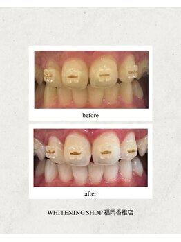 ホワイトニングショップ 福岡香椎店/美容ホワイトニング