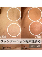 パルティノ 高崎店/ほうれい線・ほほ毛穴開き・