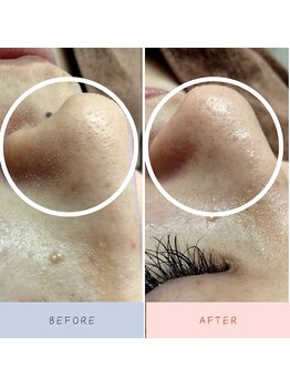 サロン ピューパ(Salon pupa)/毛穴洗浄Before→After