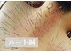 ハリキュア(Hari-Cure)の写真