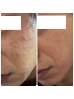 アイドット(EYE.)/ハーブピーリング