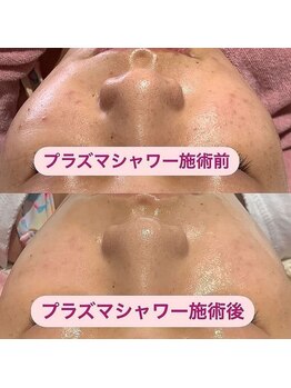 オアシス カナヤマ(Oasis kanayama)/【プラズマシャワー】
