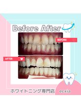 エクシアホワイトニング 札幌中島公園店/BeforeAfter［ホワイトニング］ 