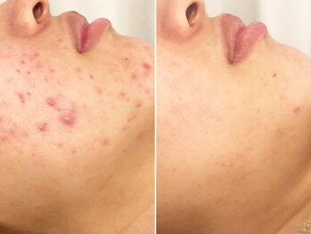 ハダイ(HADAY)/ニキビ改善｜ハーブピーリング