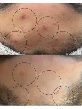 リアン(Lien)/ハーブピーリング10日後♪