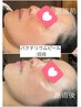 【4回セット】【脱！サビ肌】バクテリウムピール　4回セット　￥30,000