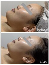 フィフ(fif)/ラミピール×カーボキシー