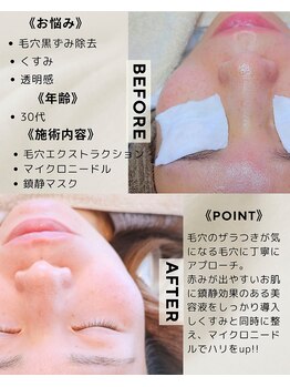 サロン ザ プマロ(SalonThePumalo)/毛穴ケア、マイクロニードル