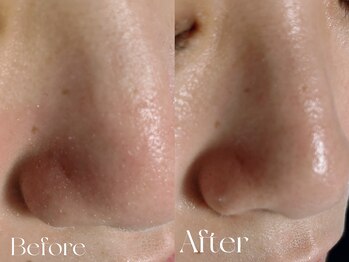 ウィハナ(wehana)/【毛穴洗浄×ララピール】