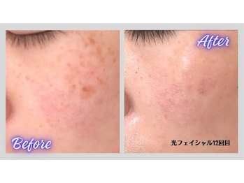 リボーン(Re bone)/大人気の光フェイシャル★