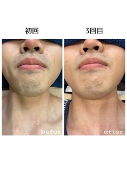 シャルム(Charme)/ひげ脱毛