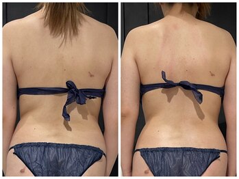 クリア(CLEAR)/リヴァイセルボディ　1回目結果