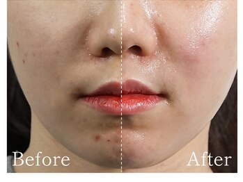 マイン 池袋店(mine)/ララピール LHALA 韓国肌管理