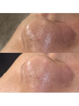 スイ 四条烏丸(SUI)/〇毛穴洗浄