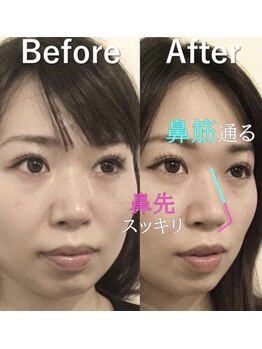 ラプリ 横浜店(Raplit)/隆鼻+輪郭矯正40分