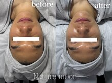 ナチュールムーン(Nature moon.)/ハーブピーリング