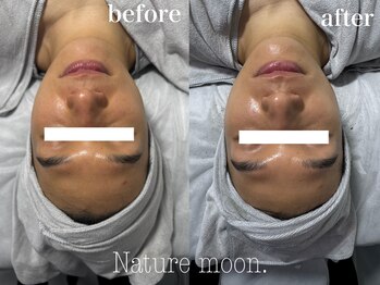 ナチュールムーン(Nature moon.)/ハーブピーリング