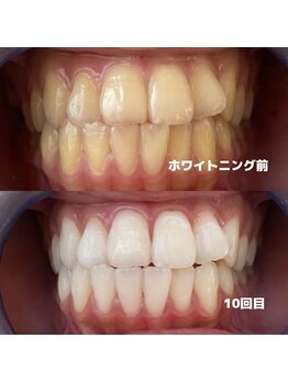 ホワイトニングビューティー 行橋店/田川ホワイトニング