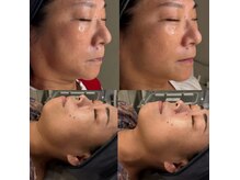 メルト 中目黒(Melt.)の雰囲気（たるみ・もたつきにアプローチした高出カサーマジェン施術）