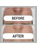【定番ヒト幹ケア】角質＆毛穴洗浄＋乳歯100％導入＋細胞活性＆導入＋パック