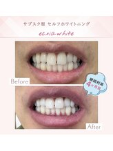 セルフホワイトニングサロン　エクシアホワイトニング宇治小倉店/ビフォーアフター
