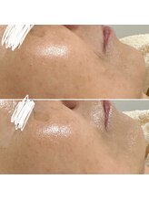 ハーナウ ハウ(hanau hou)/ハーブピーリング効果